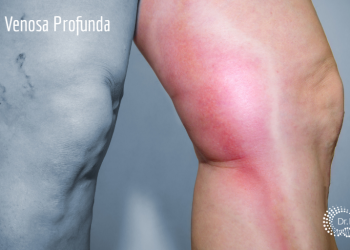 Exercícios físicos tratam e previnem Trombose Venosa