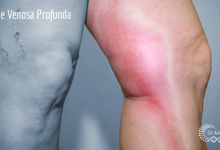 Exercícios físicos tratam e previnem Trombose Venosa