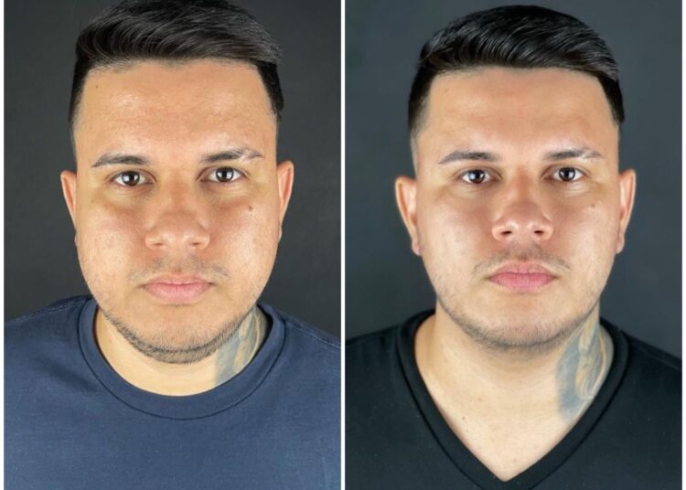 Procedimentos minimamente invasivos para emagrecimento do rosto viram os queridinhos do momento