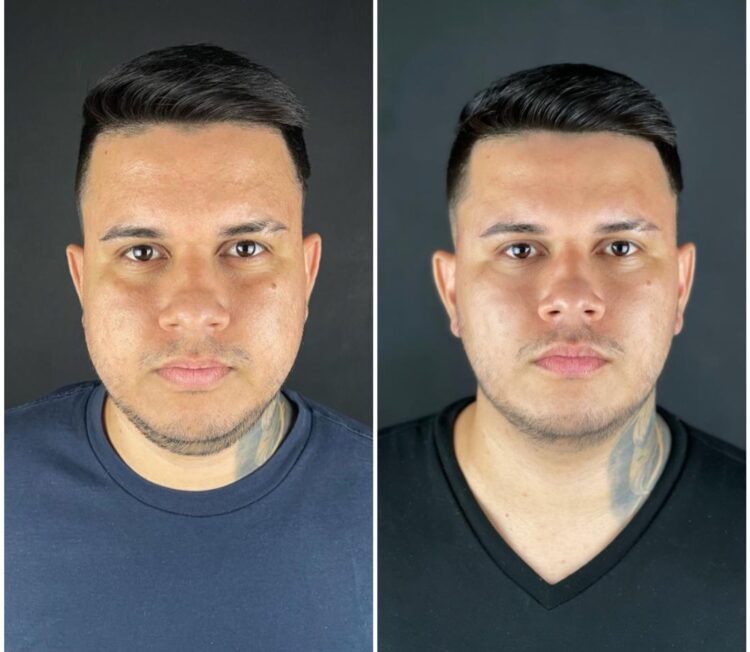 Procedimentos minimamente invasivos para emagrecimento do rosto viram os queridinhos do momento