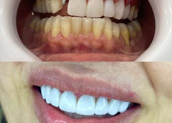 Setor de implantes dentários cresce na pandemia