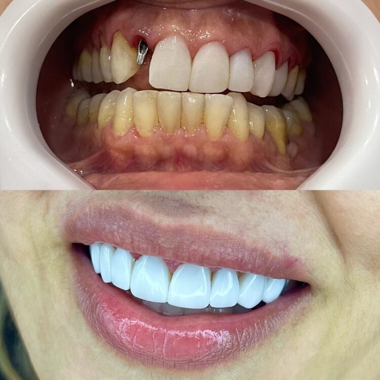 Setor de implantes dentários cresce na pandemia