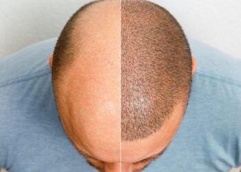 Transplante Capilar em Fortaleza: Tudo o que você precisa saber sobre a solução para queda de cabelo