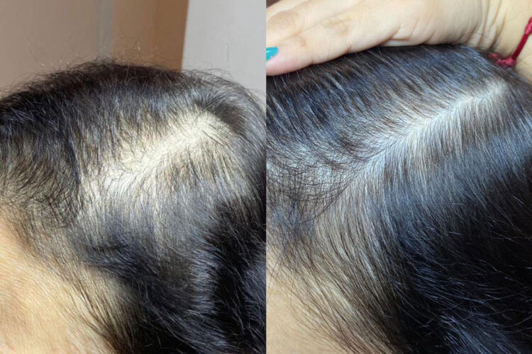Dra Mirian Lima lança linha de produtos que combatem a calvice